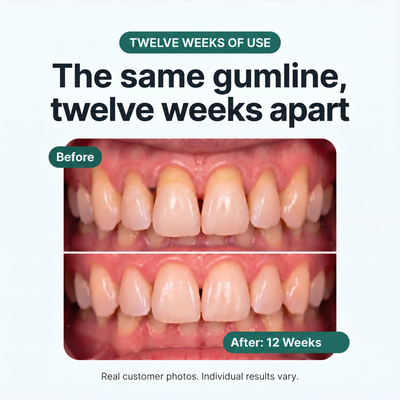 Rebuild Receding & Damaged Gums - CollaGum™
