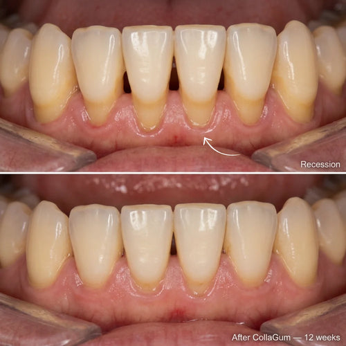 Rebuild Receding & Damaged Gums - CollaGum™