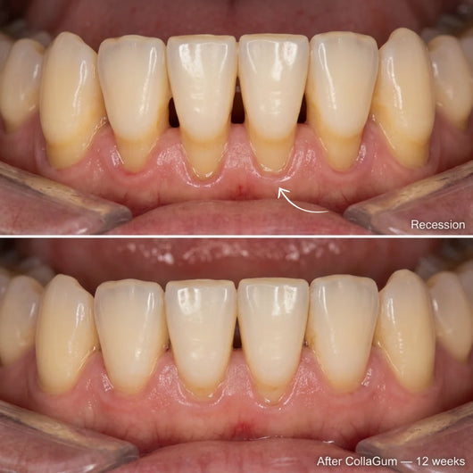 Rebuild Receding & Damaged Gums - CollaGum™