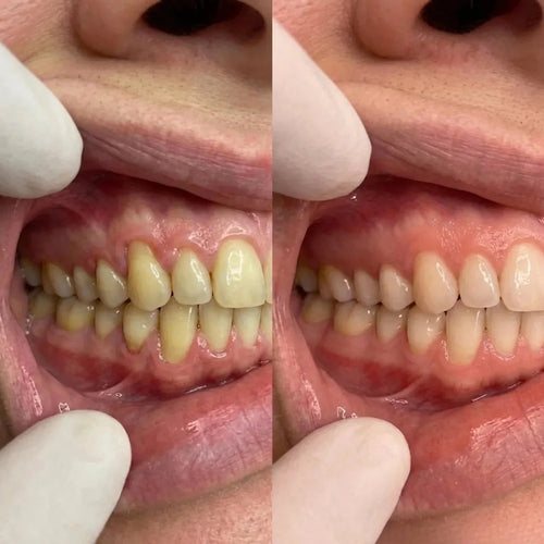 Rebuild Receding & Damaged Gums - CollaGum™